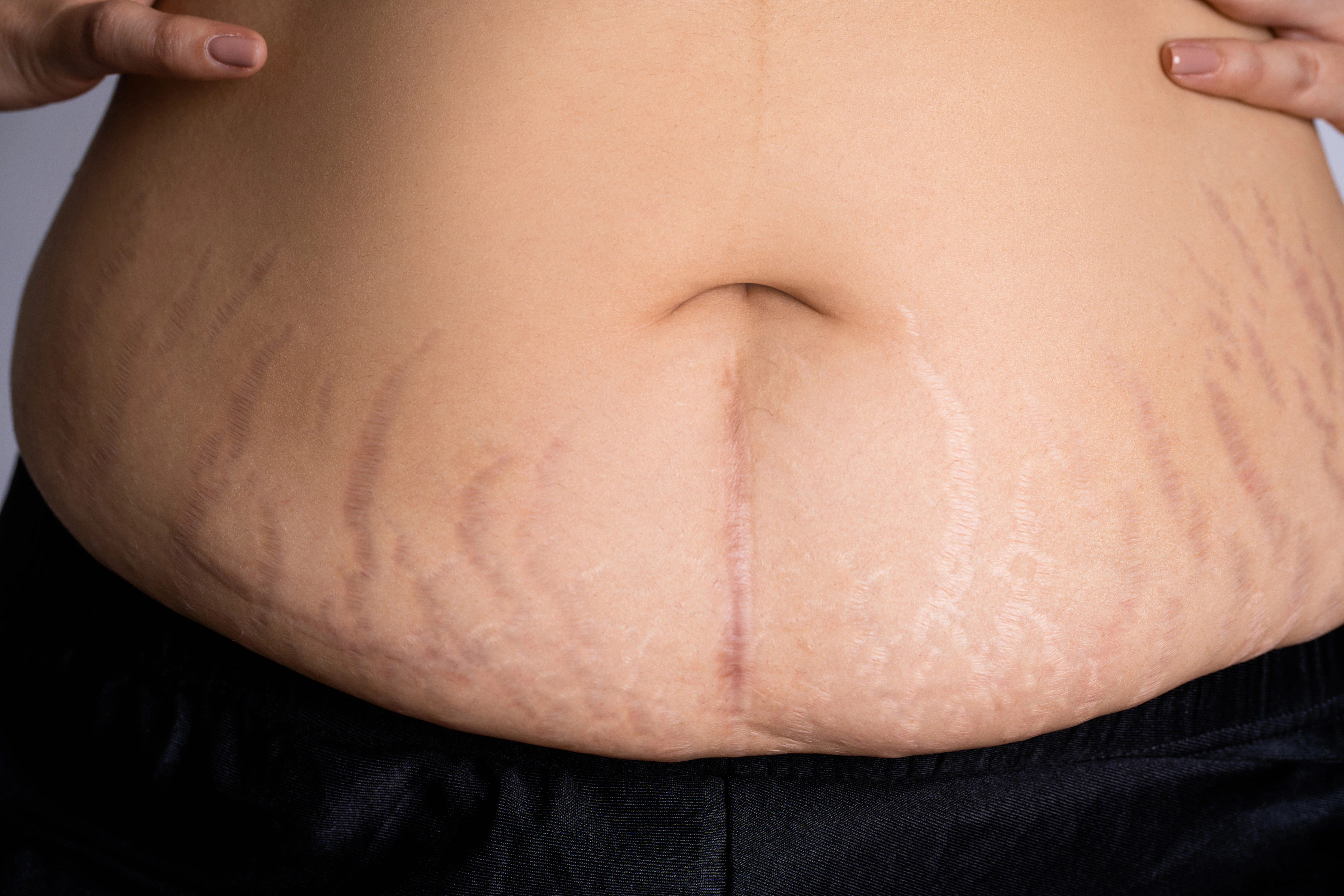 VistaCreate-626610822-stock-photo-belly-pattern-fat-stomach-woman-1.jpg#asset:479